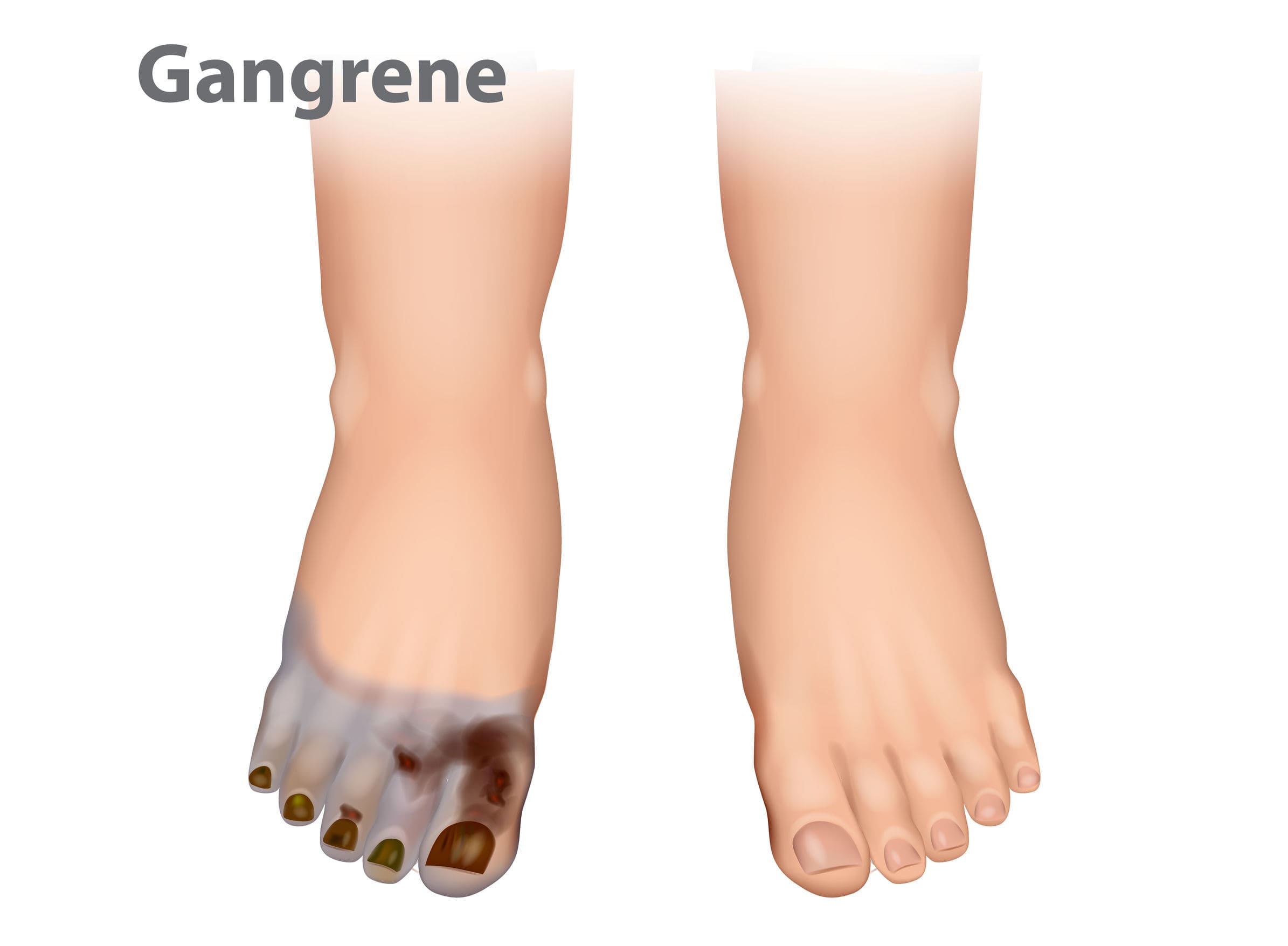 Gas Gangrene Hyperbaric Therapy