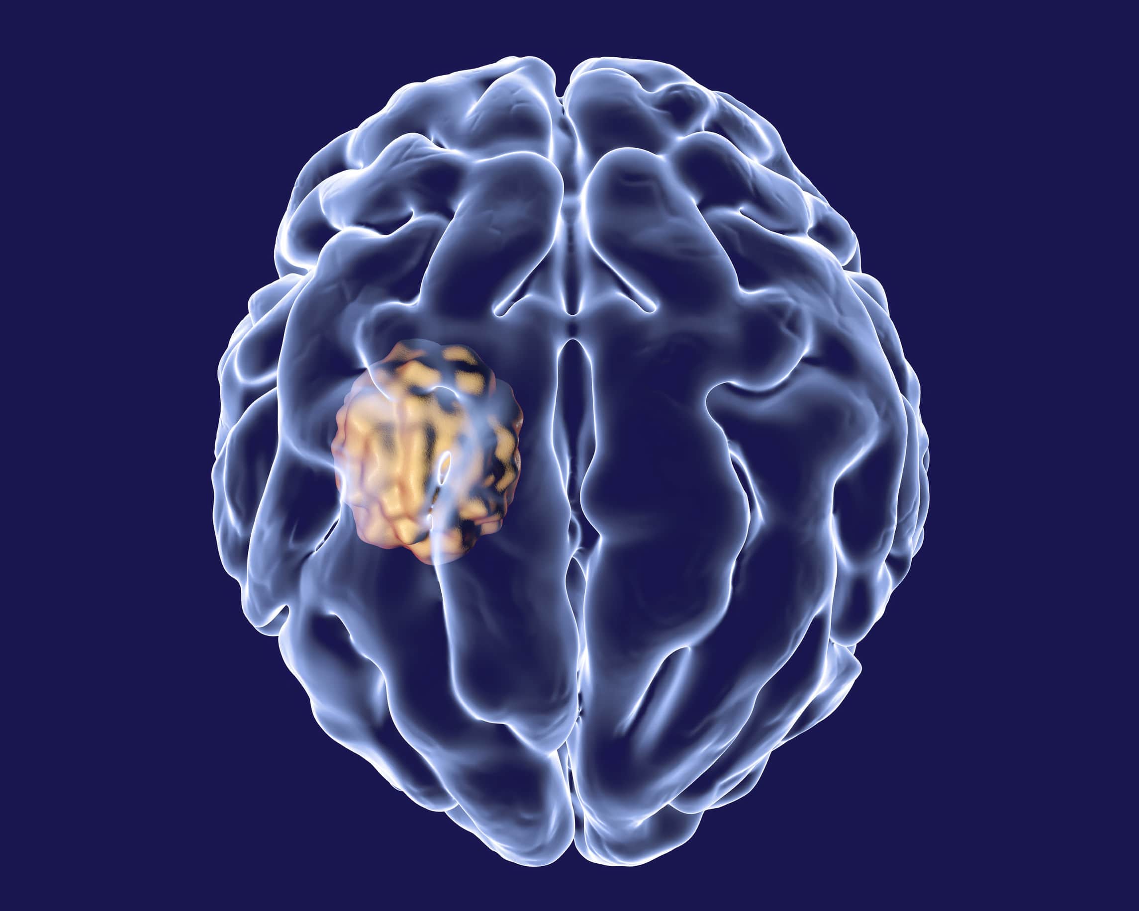 Intracranial Abscess Hyperbaric Therapy