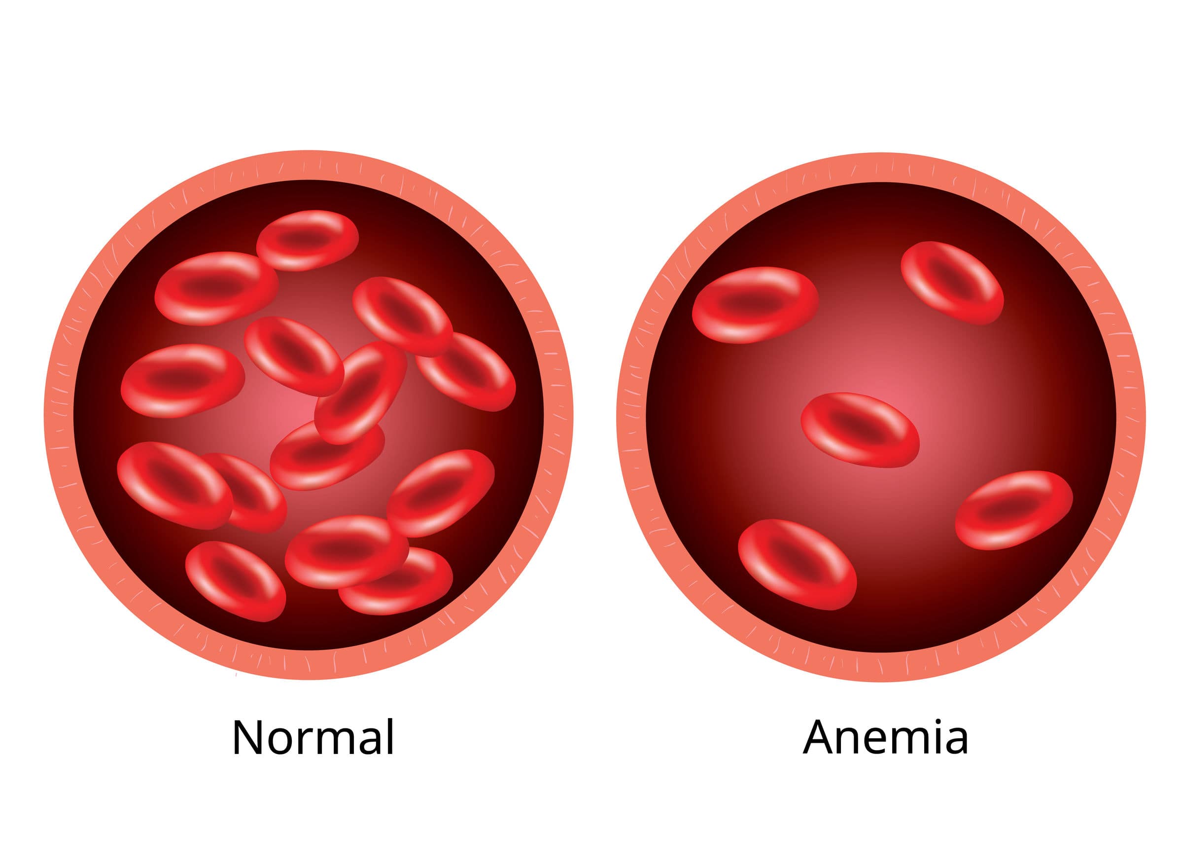 anemia-hyperbaric-therapy